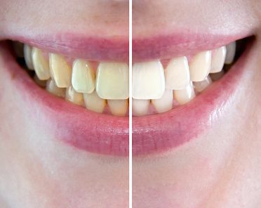 Sbiancamento dentale: quando farlo e come funziona?