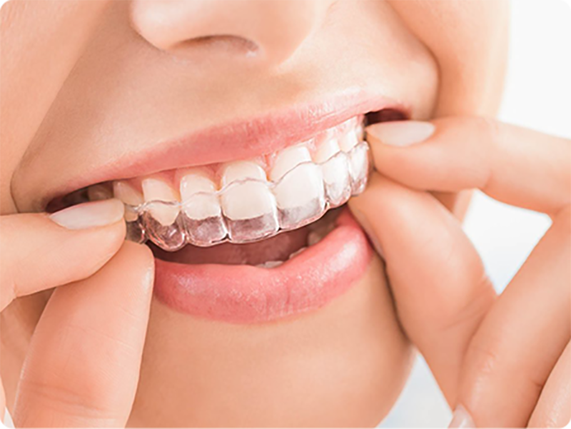 allineatori trasparenti bussolengo