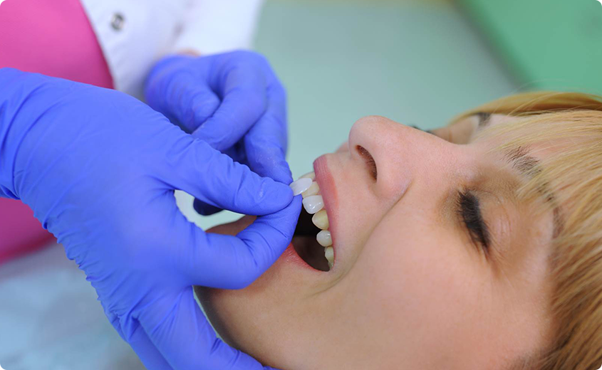 faccette dentali bussolengo