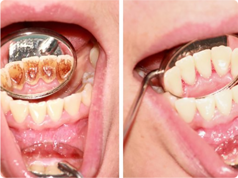 pulizia denti bussolengo