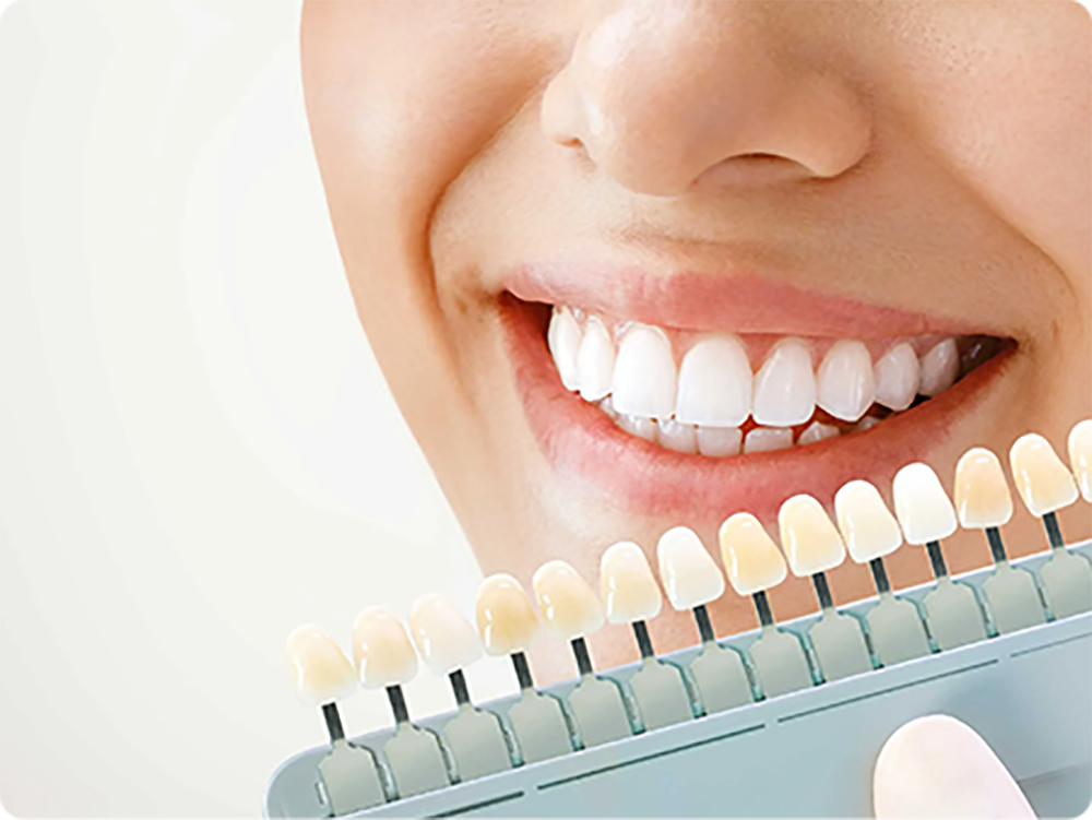 sbiancamento denti bussolengo