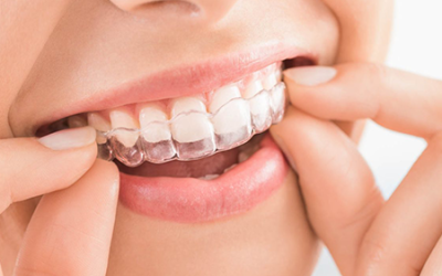 Ortodonzia tradizionale ed estetica per adulti e bambini