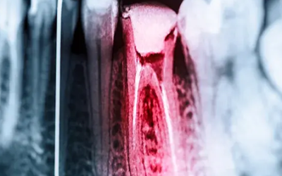 Endodonzia (cura canalare)