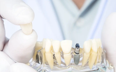 Implantologia e chirurgia orale avanzata